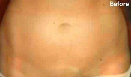 Liposuction Before & After Patient #2888