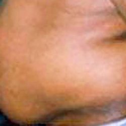Liposuction Male Before & After Patient #2921