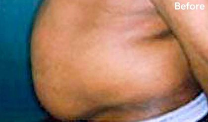 Liposuction Male Before & After Patient #2921