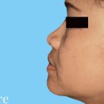 Rhinoplasty Before & After Patient #3006