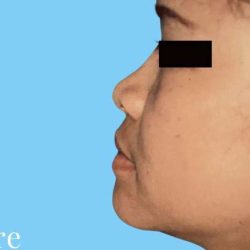 Rhinoplasty Before & After Patient #3006