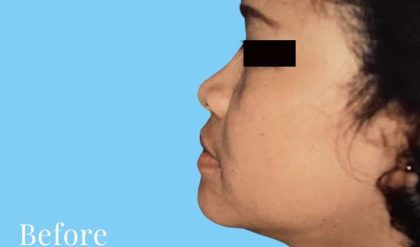 Rhinoplasty Before & After Patient #3006