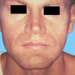 Rhinoplasty Male Before & After Patient #3042