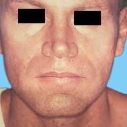 Rhinoplasty Male Before & After Patient #3042