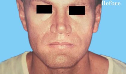 Rhinoplasty Male Before & After Patient #3042
