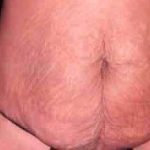Tummy Tuck Before & After Patient #3081
