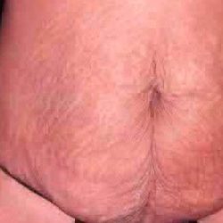 Tummy Tuck Before & After Patient #3081