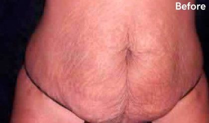 Tummy Tuck Before & After Patient #3081