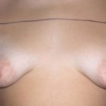 Breast Augmentation Before & After Patient #2262