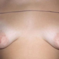 Breast Augmentation Before & After Patient #2262