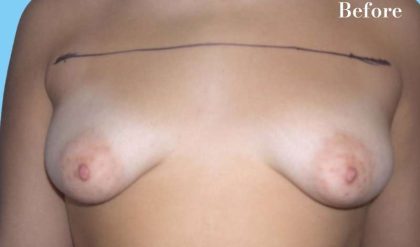 Breast Augmentation Before & After Patient #2262