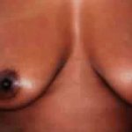 Breast Lift Before & After Patient #2300