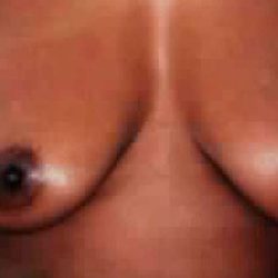 Breast Lift Before & After Patient #2300