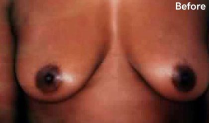 Breast Lift Before & After Patient #2300