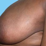 Breast Reduction Before & After Patient #2366