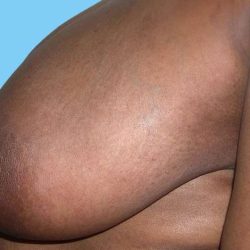 Breast Reduction Before & After Patient #2366