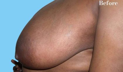 Breast Reduction Before & After Patient #2366