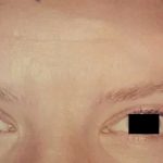 Botox Before & After Patient #2163