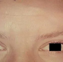 Botox Before & After Patient #2163