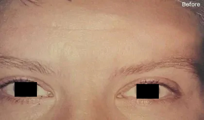 Botox Before & After Patient #2163