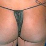 Buttock Augmentation Before & After Patient #2465