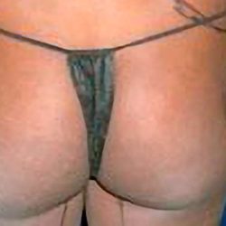 Buttock Augmentation Before & After Patient #2465
