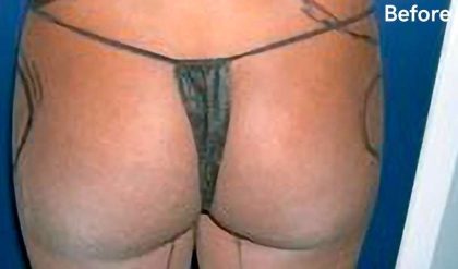Buttock Augmentation Before & After Patient #2465