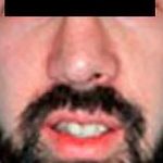 Otoplasty Male Before & After Patient #2553