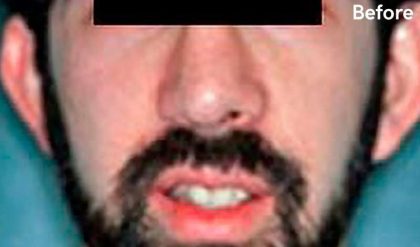 Otoplasty Male Before & After Patient #2553