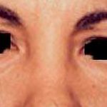 Eyelid Surgery Before & After Patient #2629