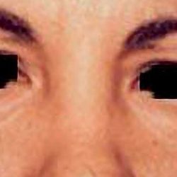 Eyelid Surgery Before & After Patient #2629