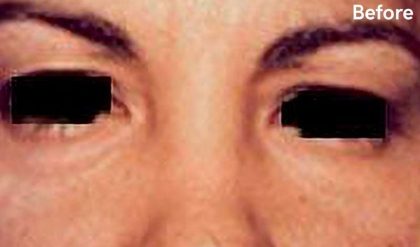 Eyelid Surgery Before & After Patient #2629
