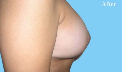Breast Augmentation Before & After Patient #2253