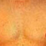 Gynecomastia Before & After Patient #2716