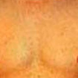 Gynecomastia Before & After Patient #2716