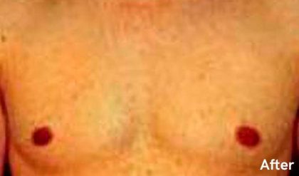 Gynecomastia Before & After Patient #2716