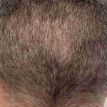 Hair Restoration Before & After Patient #2796