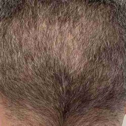 Hair Restoration Before & After Patient #2796
