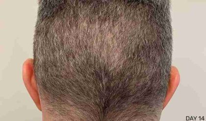 Hair Restoration Before & After Patient #2796