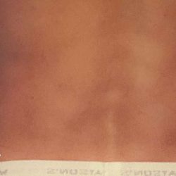 Liposuction Male Before & After Patient #2912