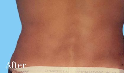 Liposuction Male Before & After Patient #2912