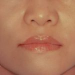 Rhinoplasty Before & After Patient #2997