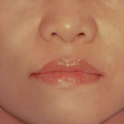 Rhinoplasty Before & After Patient #2997