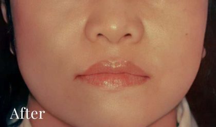 Rhinoplasty Before & After Patient #2997