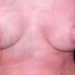 Breast Asymmetry Correction Before & After Patient #2181