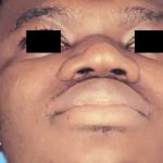 Rhinoplasty Male Before & After Patient #3033