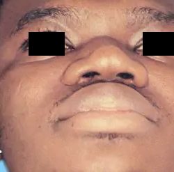 Rhinoplasty Male Before & After Patient #3033