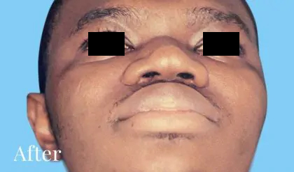 Rhinoplasty Male Before & After Patient #3033