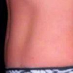 Tummy Tuck Before & After Patient #3072