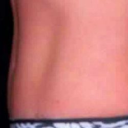 Tummy Tuck Before & After Patient #3072